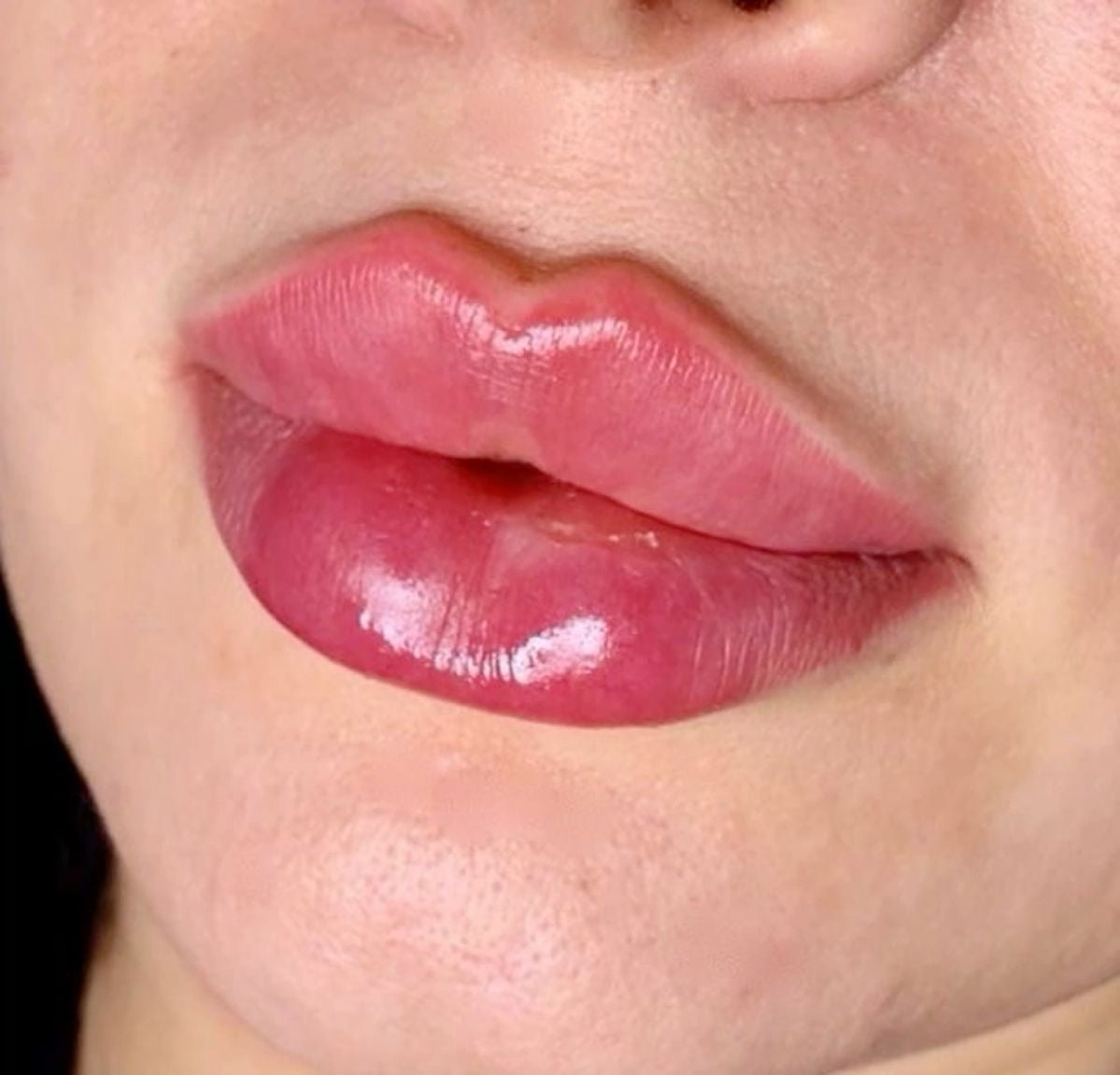 Lip Filler